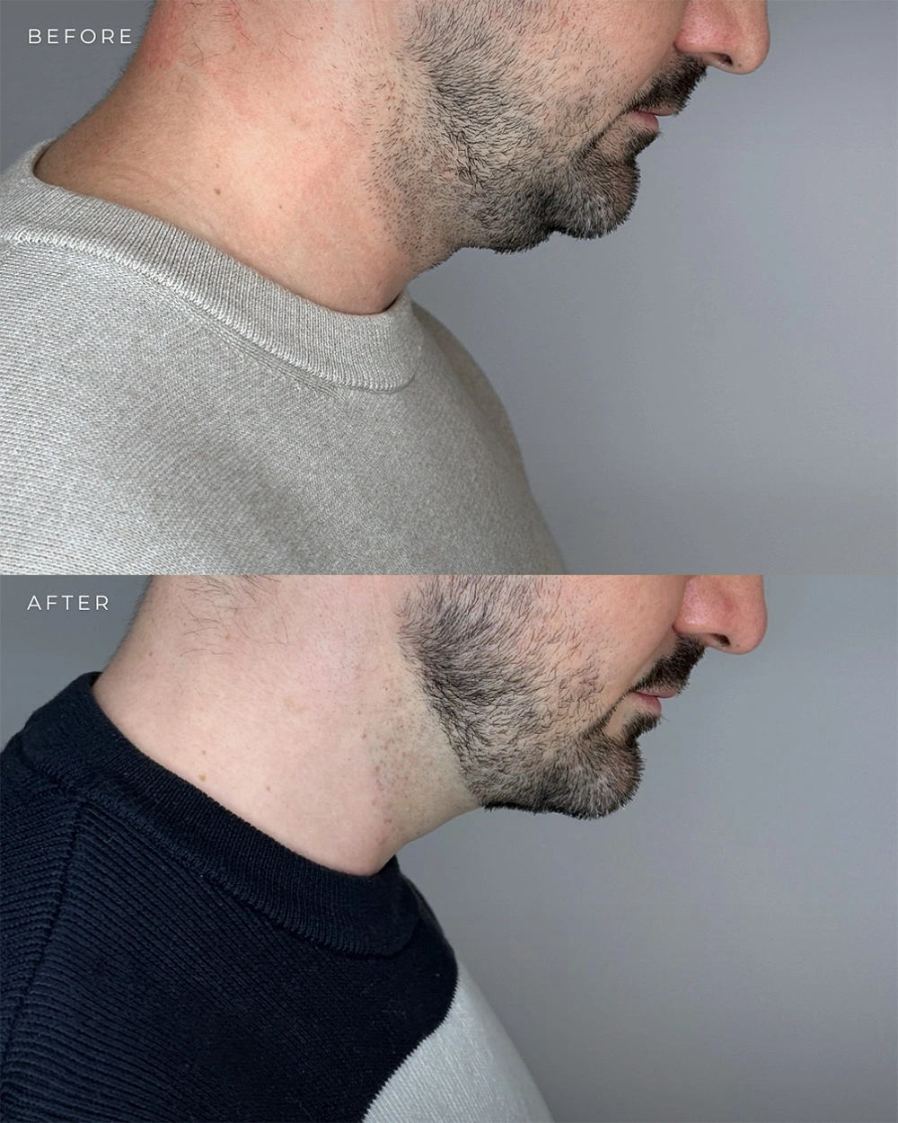Real patient results in Montreal, QC Performed by Emily Deane, MD
