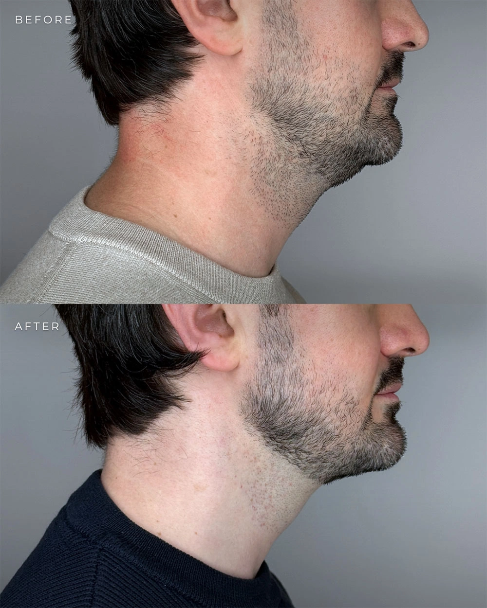 Real patient results in Montreal, QC Performed by Emily Deane, MD
