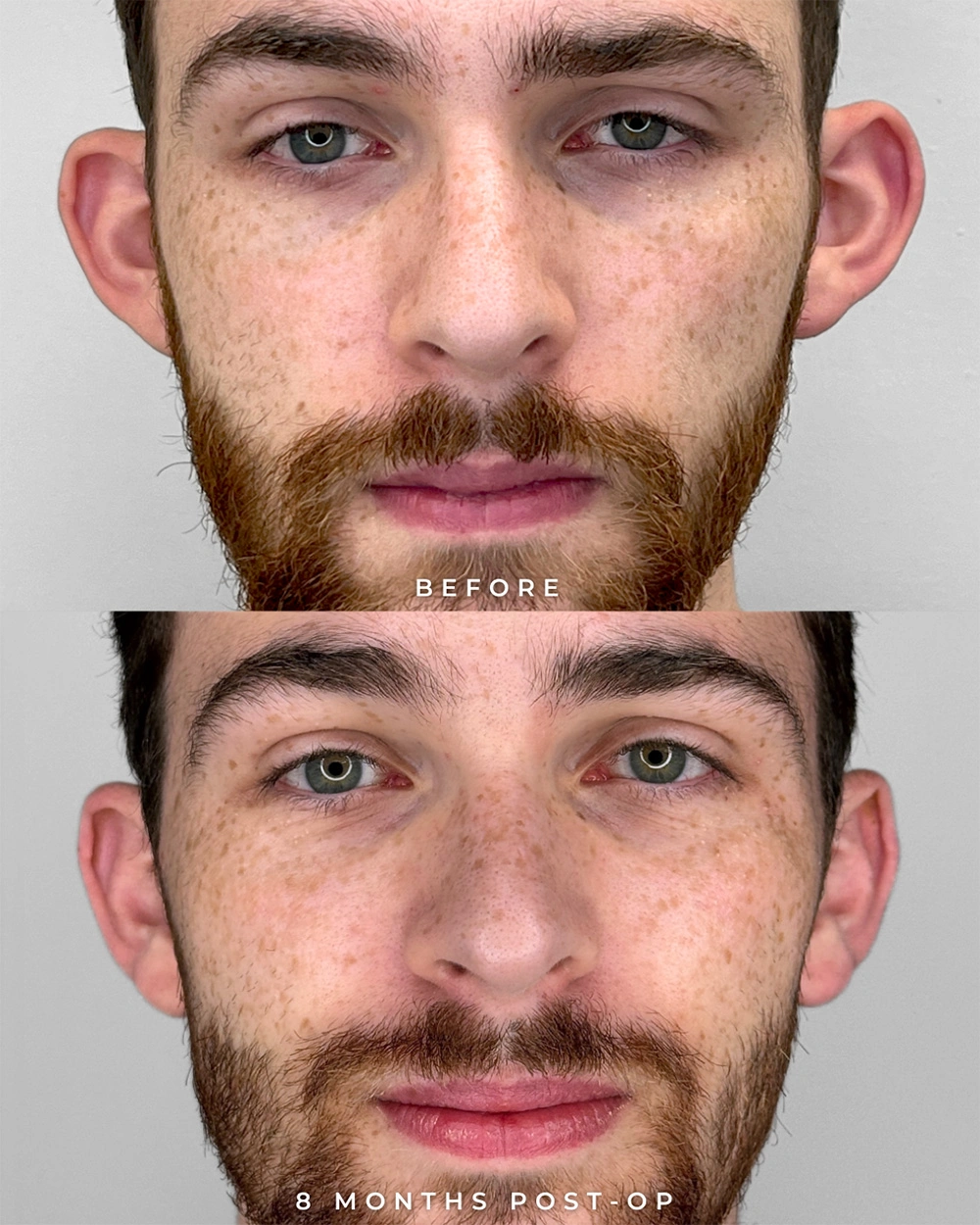 Real patient results in Montreal, QC Performed by Emily Deane, MD