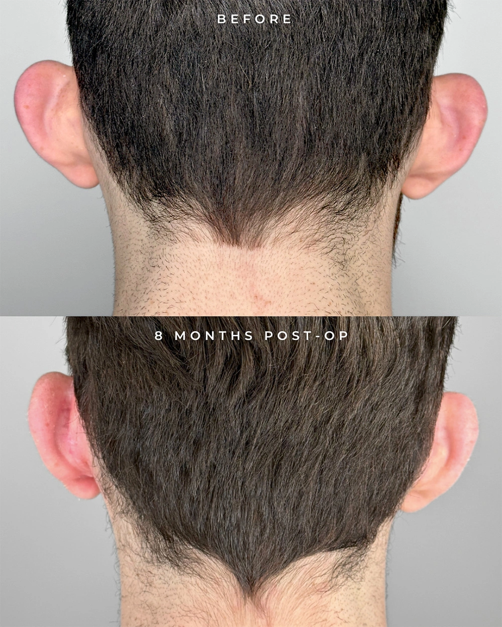 Real patient results in Montreal, QC Performed by Emily Deane, MD