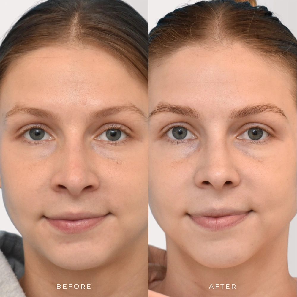 Real patient results in Montreal, QC Performed by Emily Deane, MD