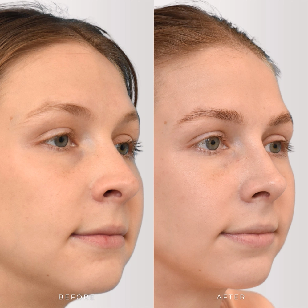 Real patient results in Montreal, QC Performed by Emily Deane, MD