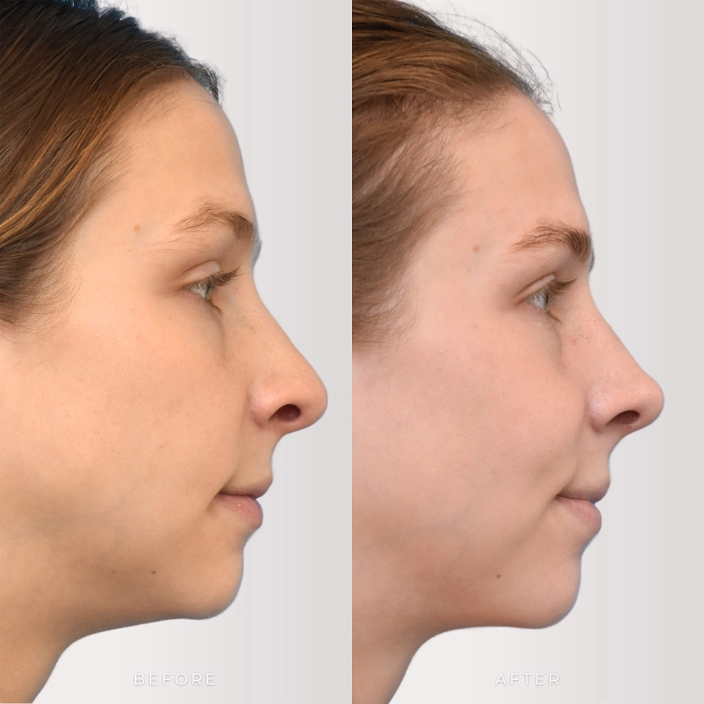 Real patient results in Montreal, QC Performed by Emily Deane, MD