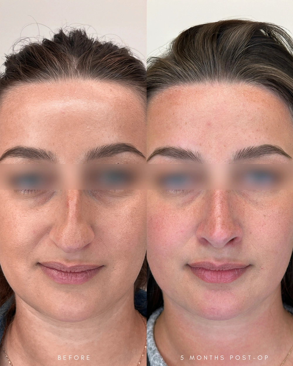 Real patient results in Montreal, QC Performed by Emily Deane, MD