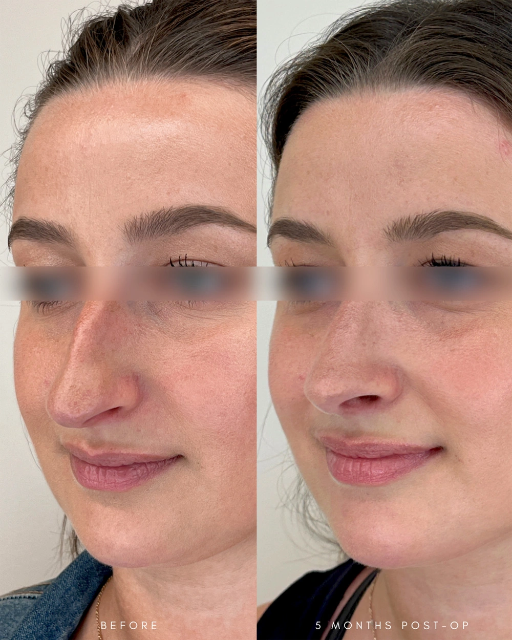 Real patient results in Montreal, QC Performed by Emily Deane, MD