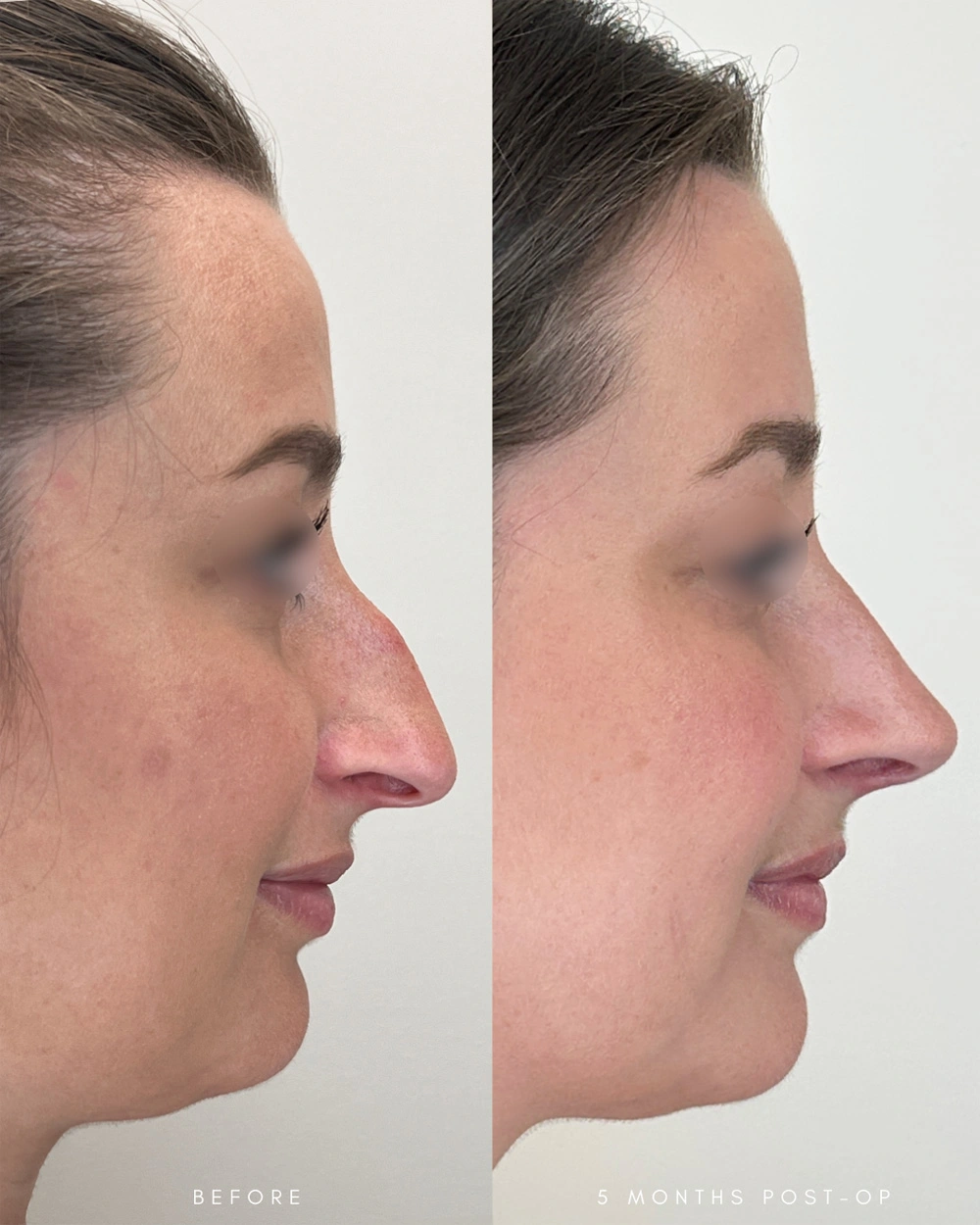 Real patient results in Montreal, QC Performed by Emily Deane, MD