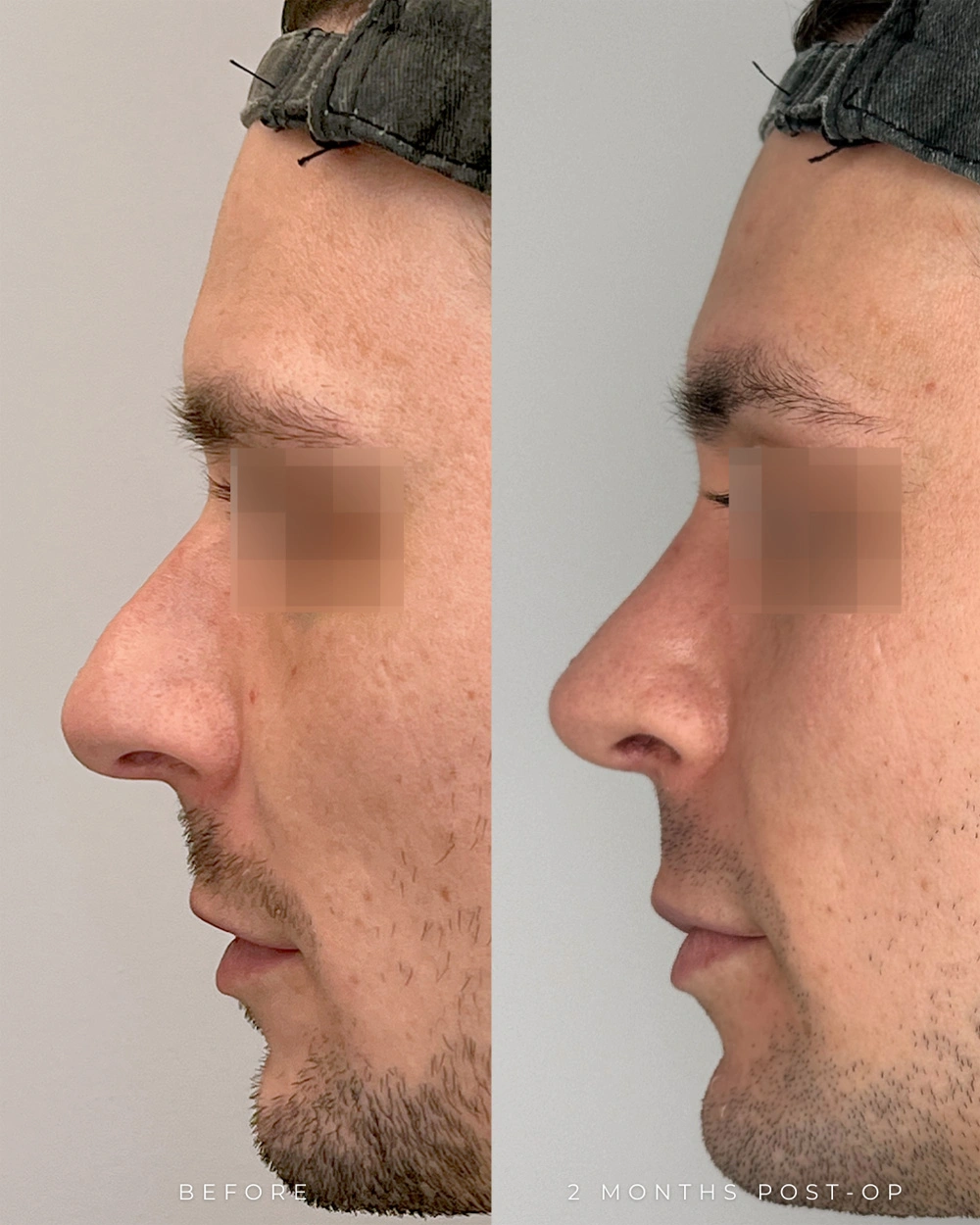 Real patient results in Montreal, QC Performed by Emily Deane, MD
