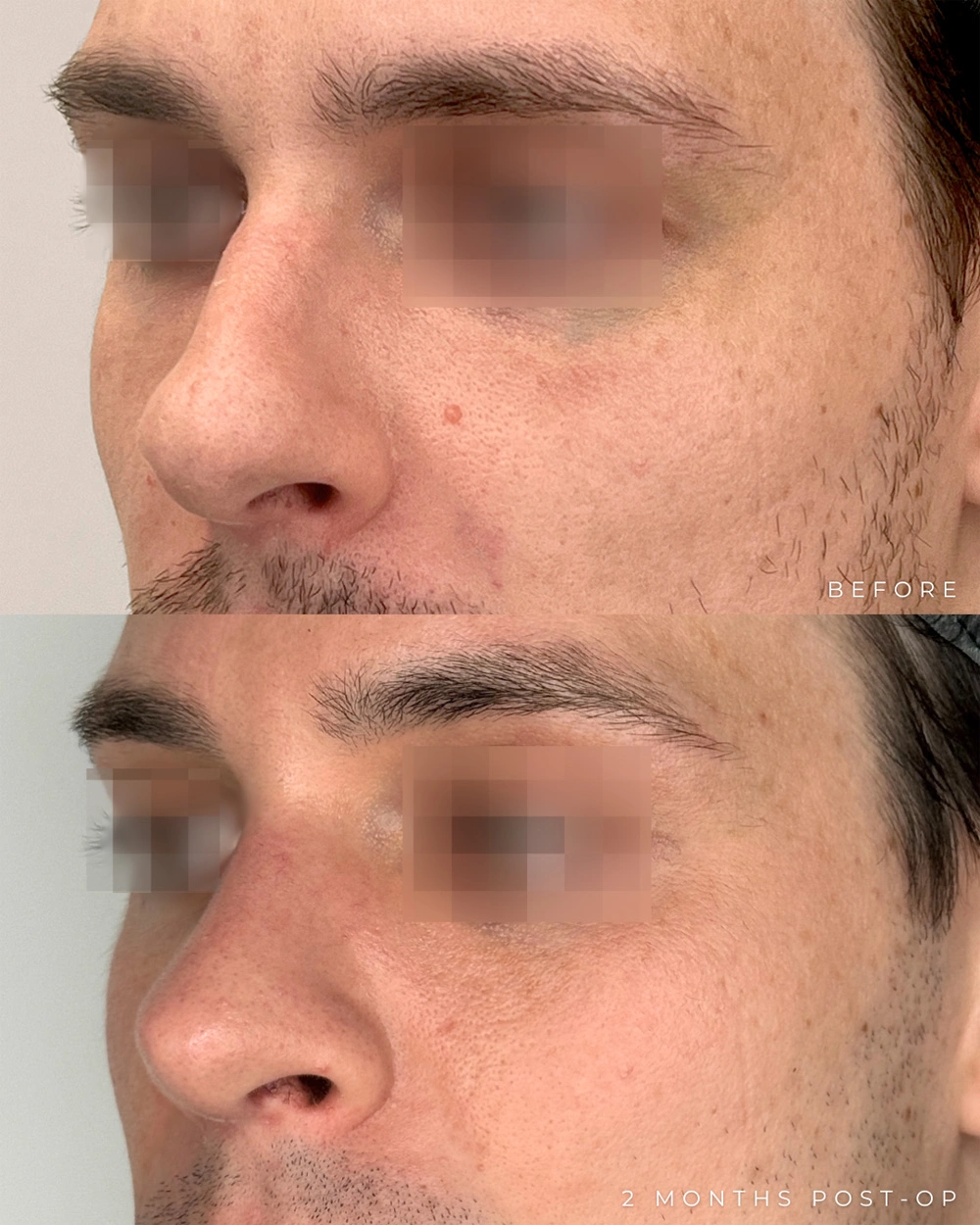 Real patient results in Montreal, QC Performed by Emily Deane, MD