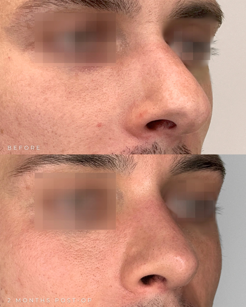 Real patient results in Montreal, QC Performed by Emily Deane, MD