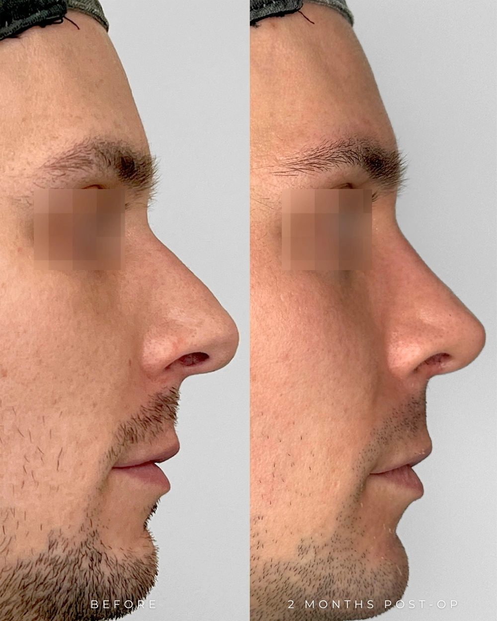 Real patient results in Montreal, QC Performed by Emily Deane, MD