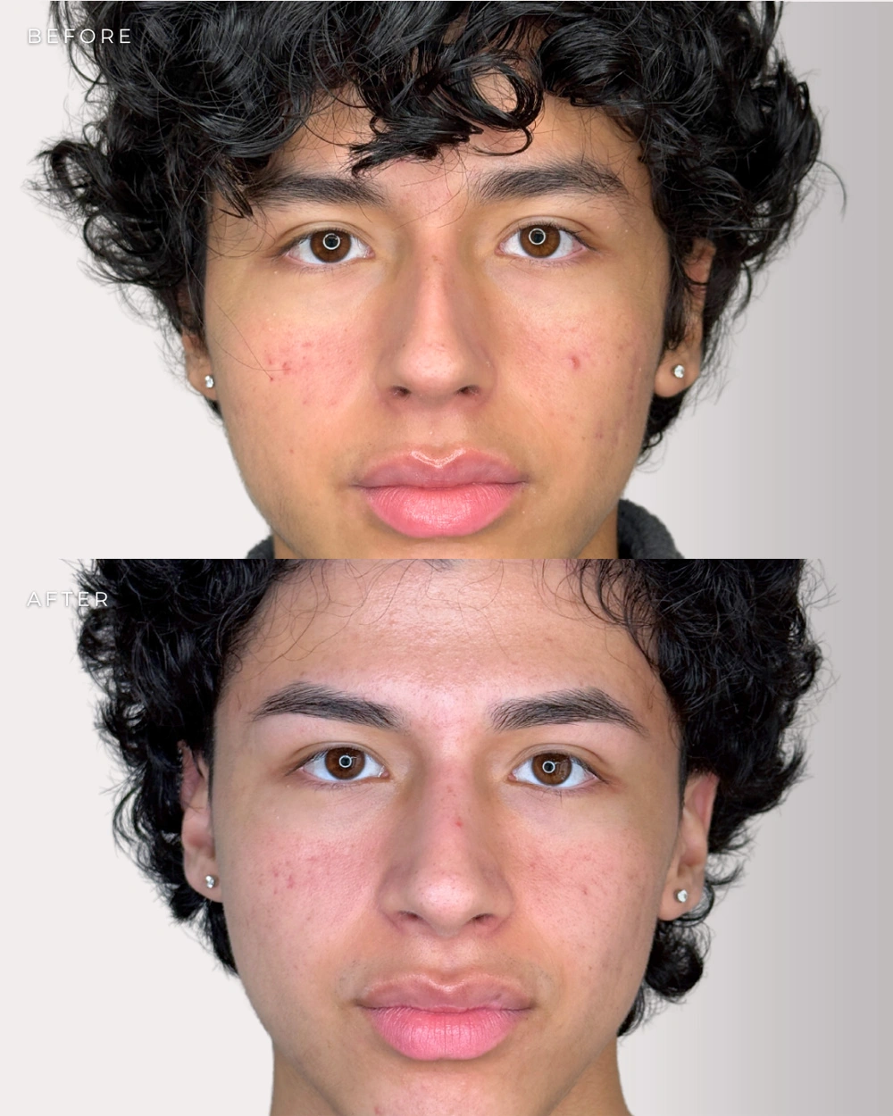 Real patient results in Montreal, QC Performed by Emily Deane, MD