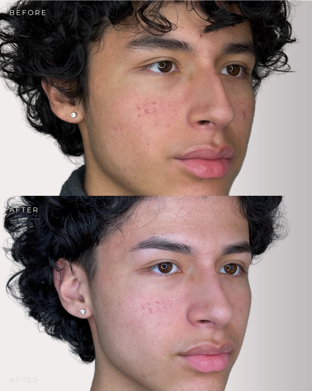 Real patient results in Montreal, QC Performed by Emily Deane, MD