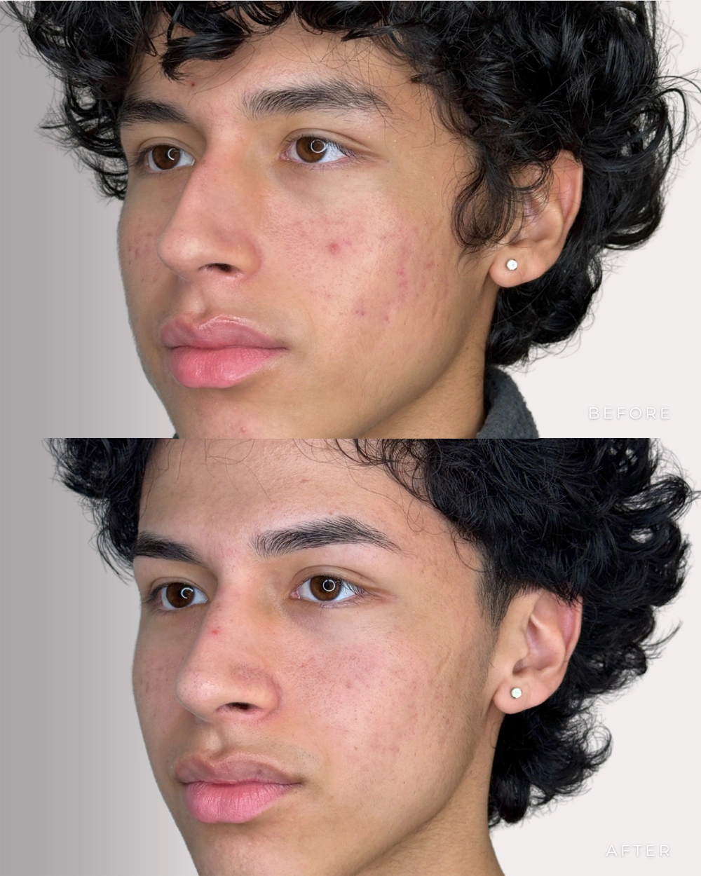 Real patient results in Montreal, QC Performed by Emily Deane, MD