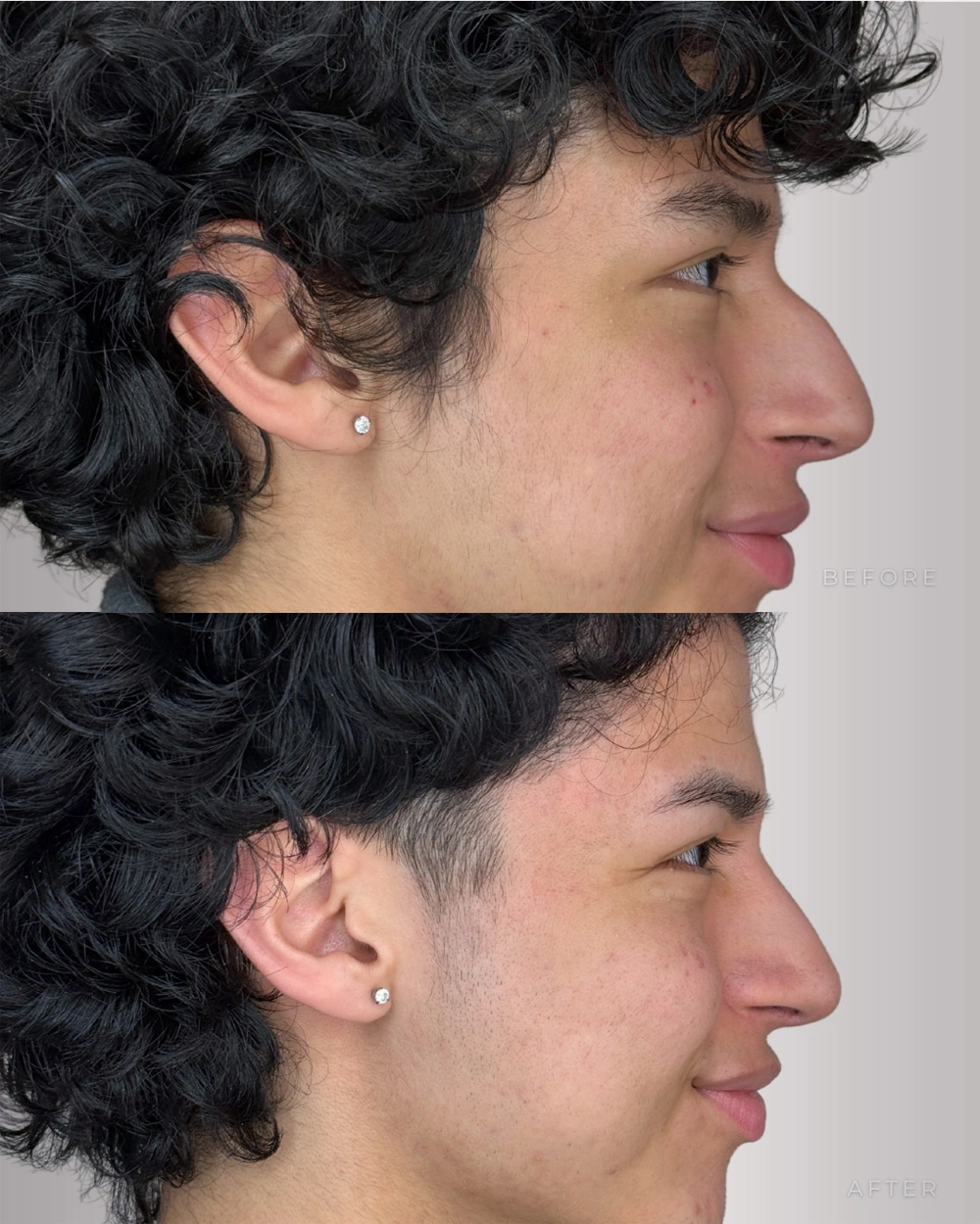 Real patient results in Montreal, QC Performed by Emily Deane, MD