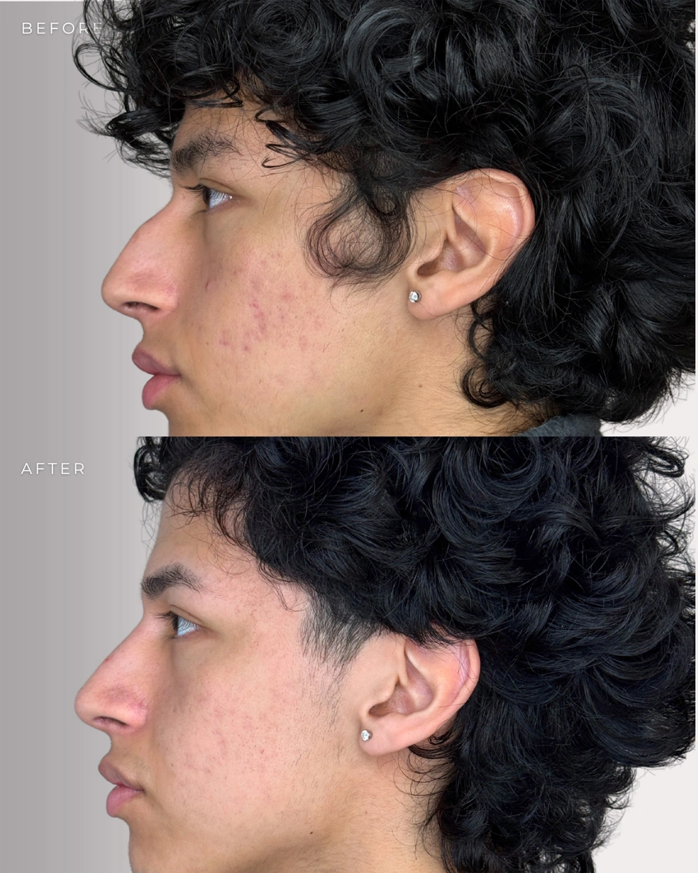 Real patient results in Montreal, QC Performed by Emily Deane, MD