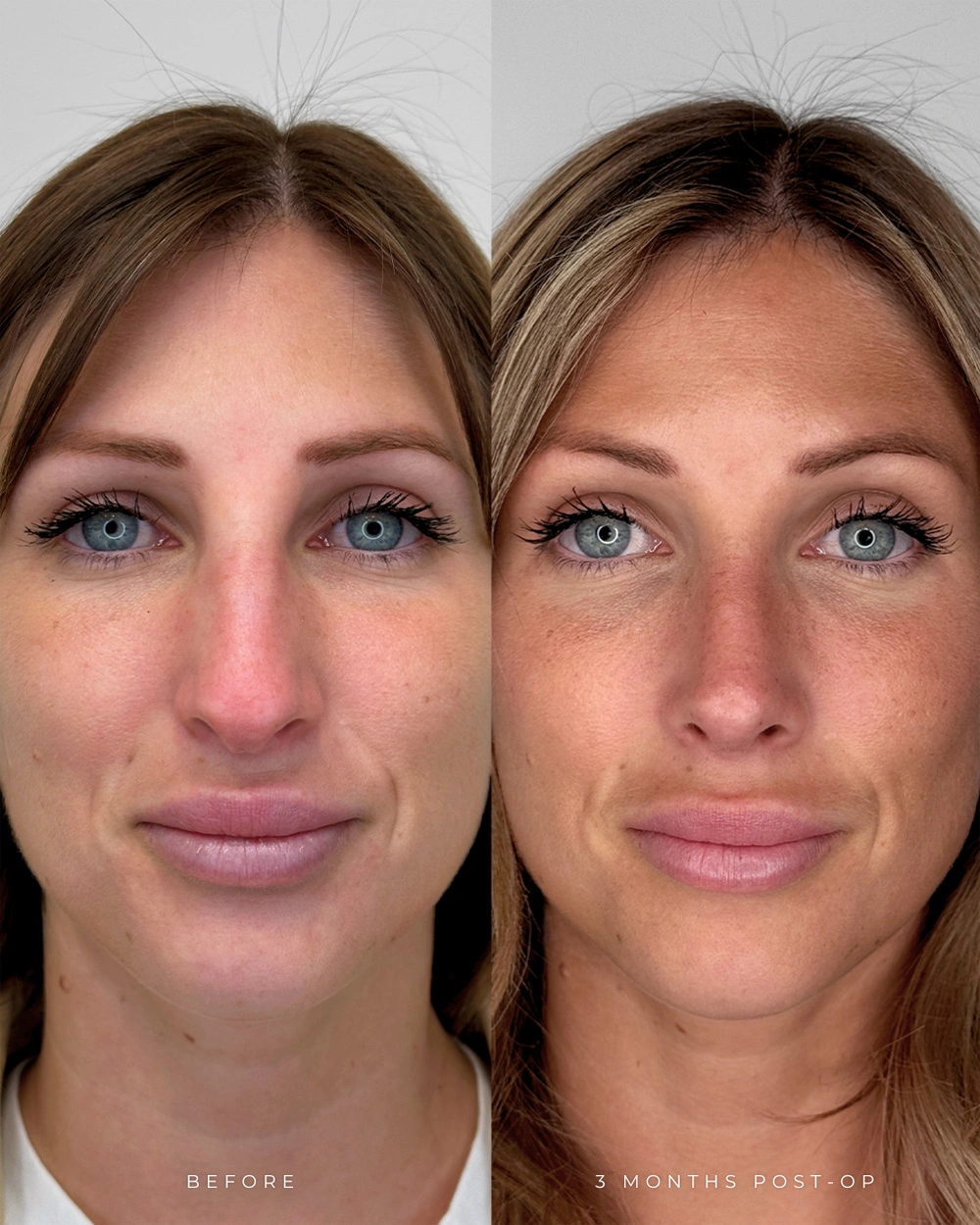 Real patient results in Montreal, QC Performed by Emily Deane, MD