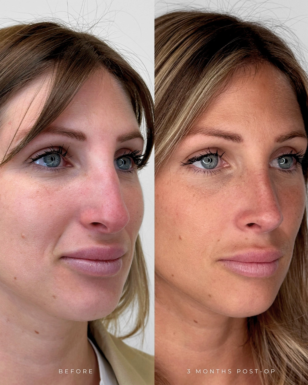 Real patient results in Montreal, QC Performed by Emily Deane, MD