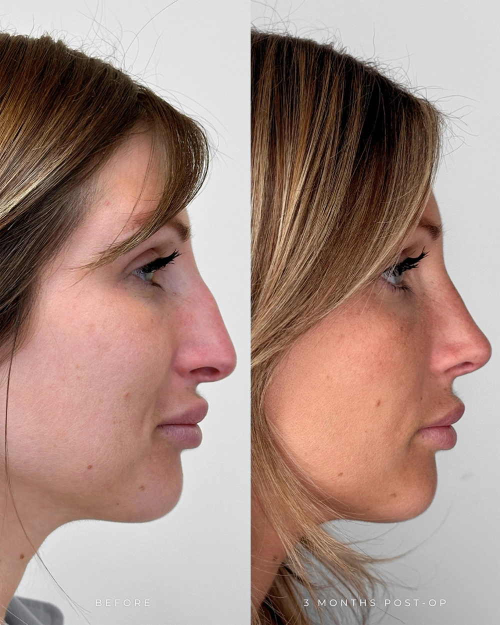 Real patient results in Montreal, QC Performed by Emily Deane, MD
