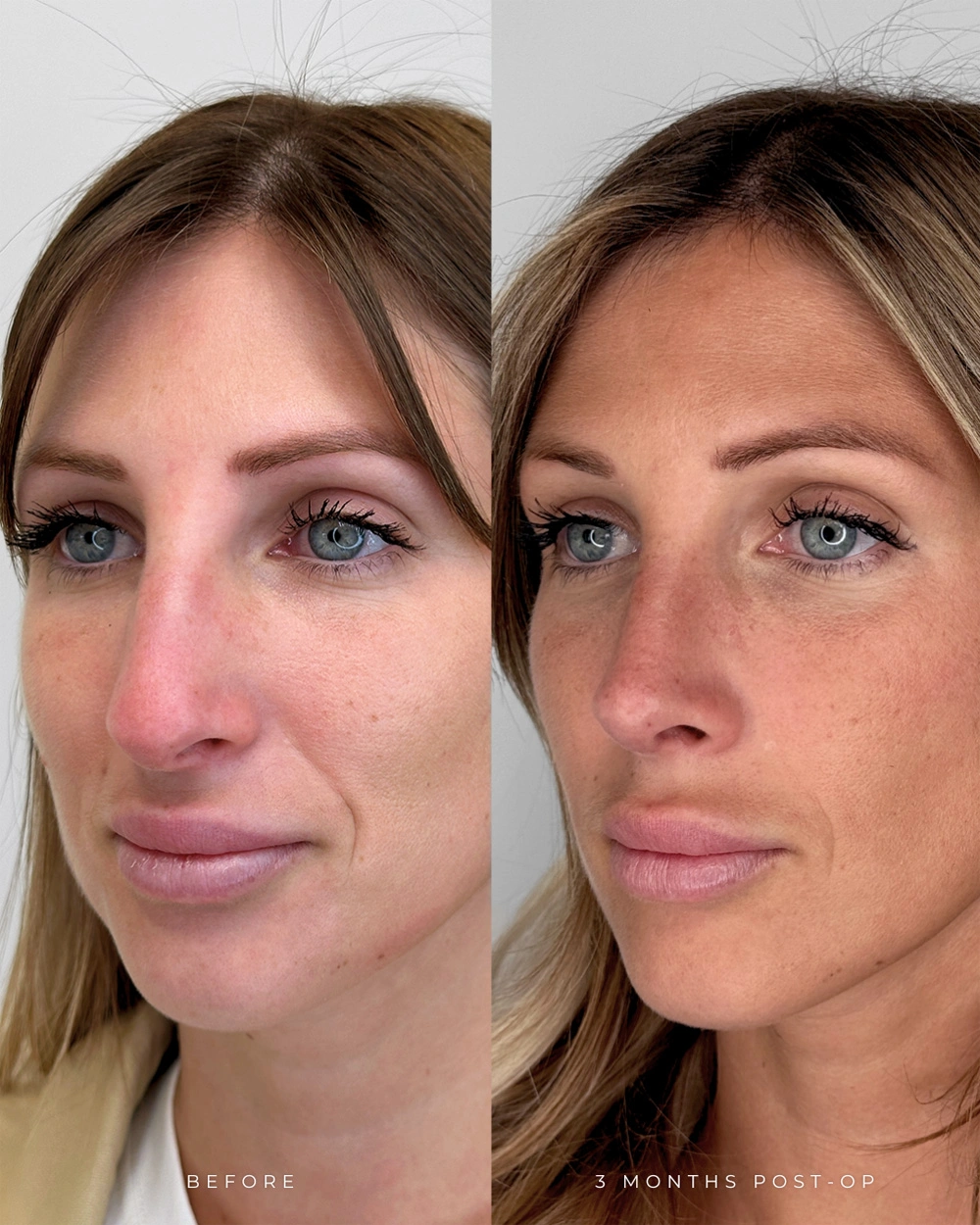 Real patient results in Montreal, QC Performed by Emily Deane, MD