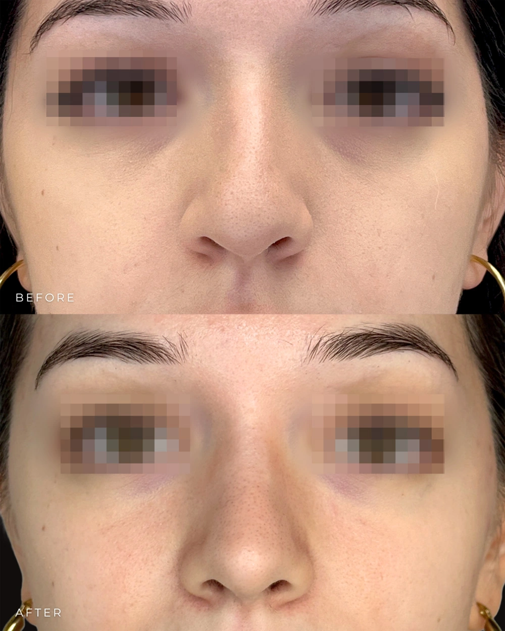 Real patient results in Montreal, QC Performed by Emily Deane, MD