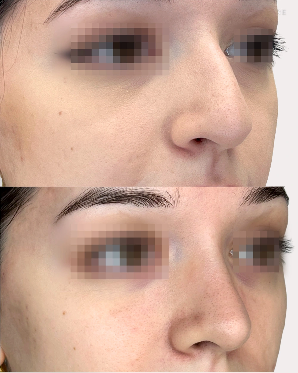 Real patient results in Montreal, QC Performed by Emily Deane, MD