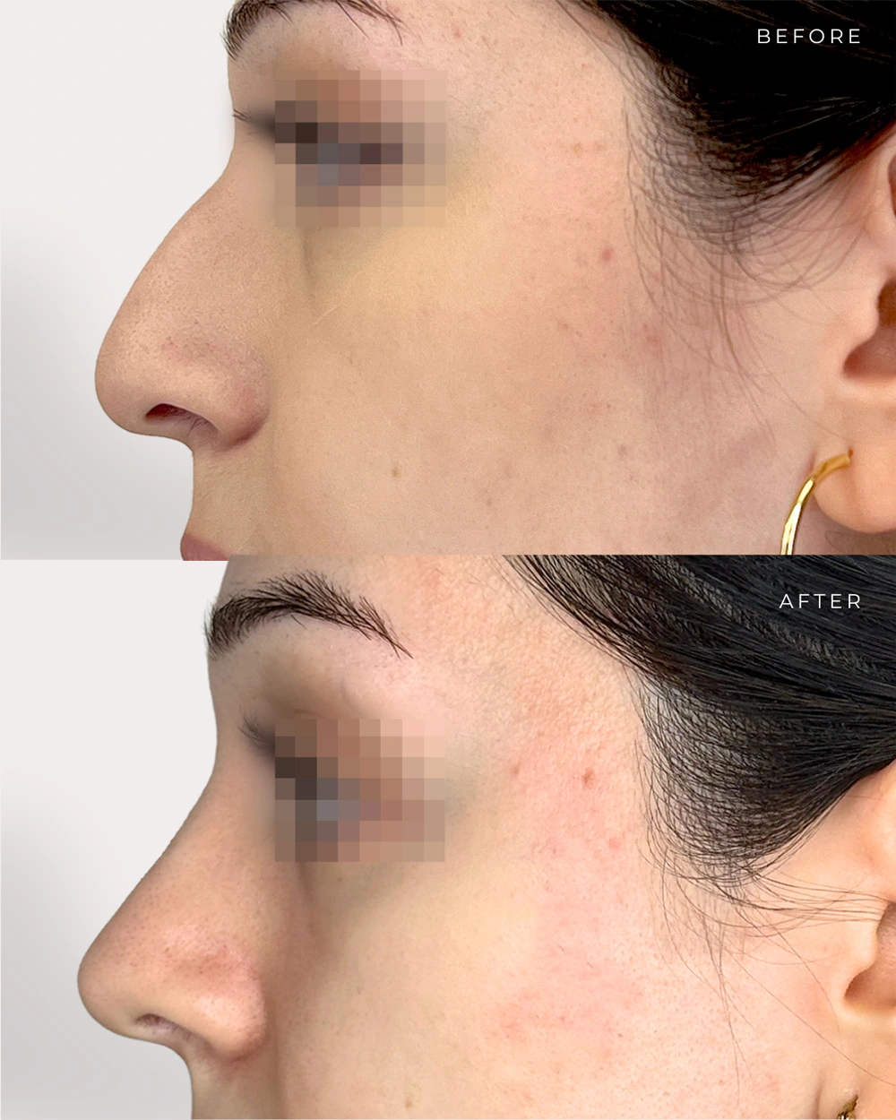 Real patient results in Montreal, QC Performed by Emily Deane, MD