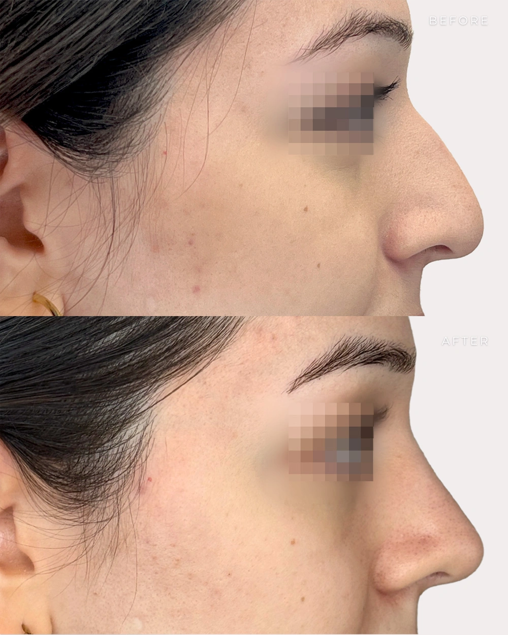 Real patient results in Montreal, QC Performed by Emily Deane, MD