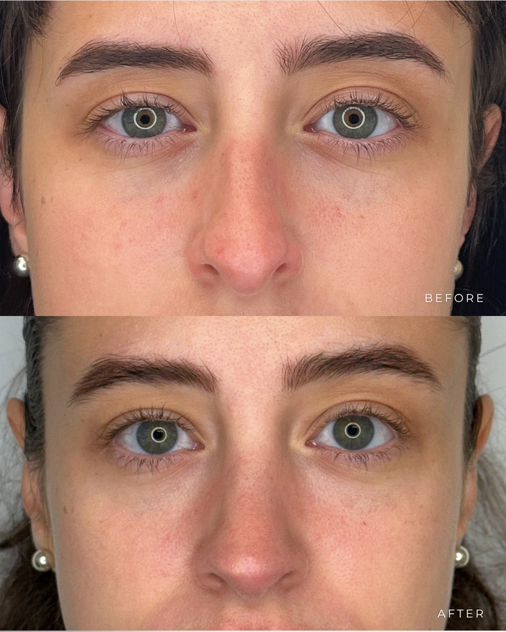 Real patient results in Montreal, QC Performed by Emily Deane, MD