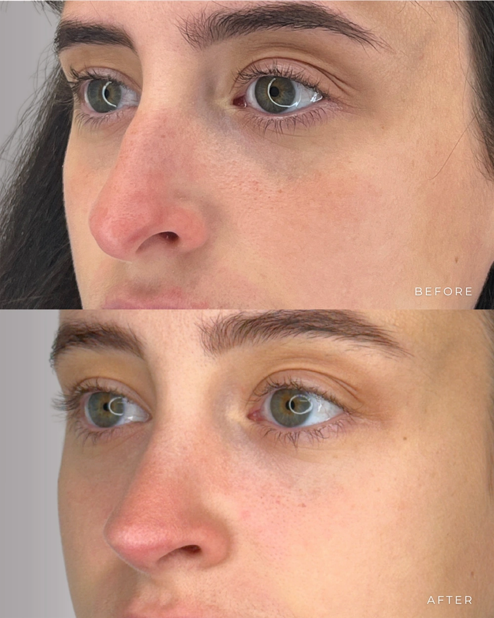 Real patient results in Montreal, QC Performed by Emily Deane, MD