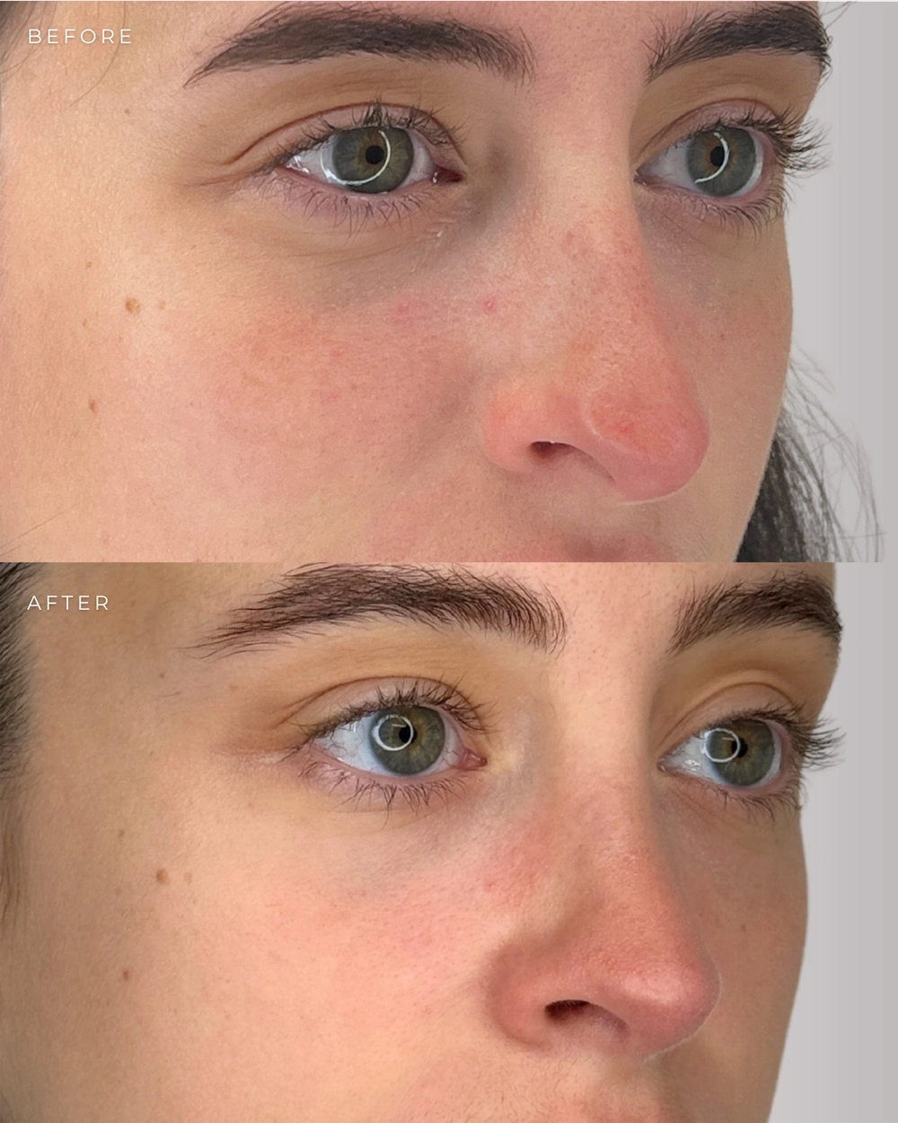 Real patient results in Montreal, QC Performed by Emily Deane, MD