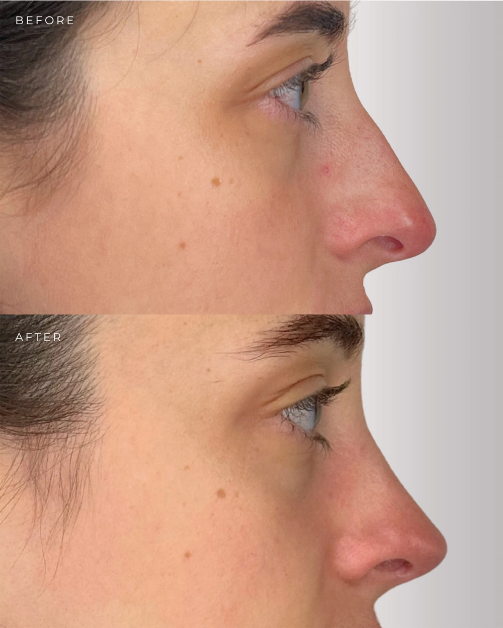 Real patient results in Montreal, QC Performed by Emily Deane, MD