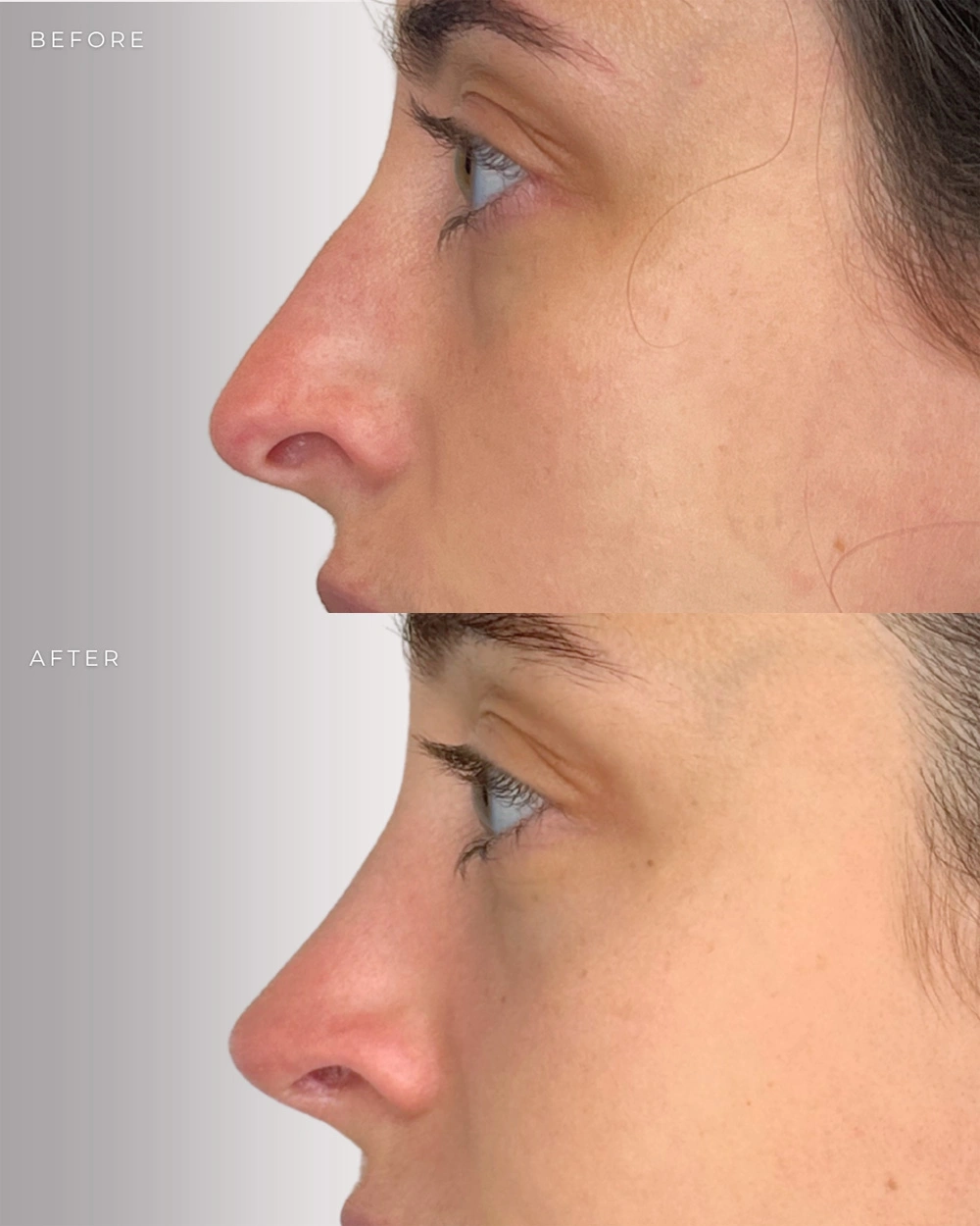Real patient results in Montreal, QC Performed by Emily Deane, MD