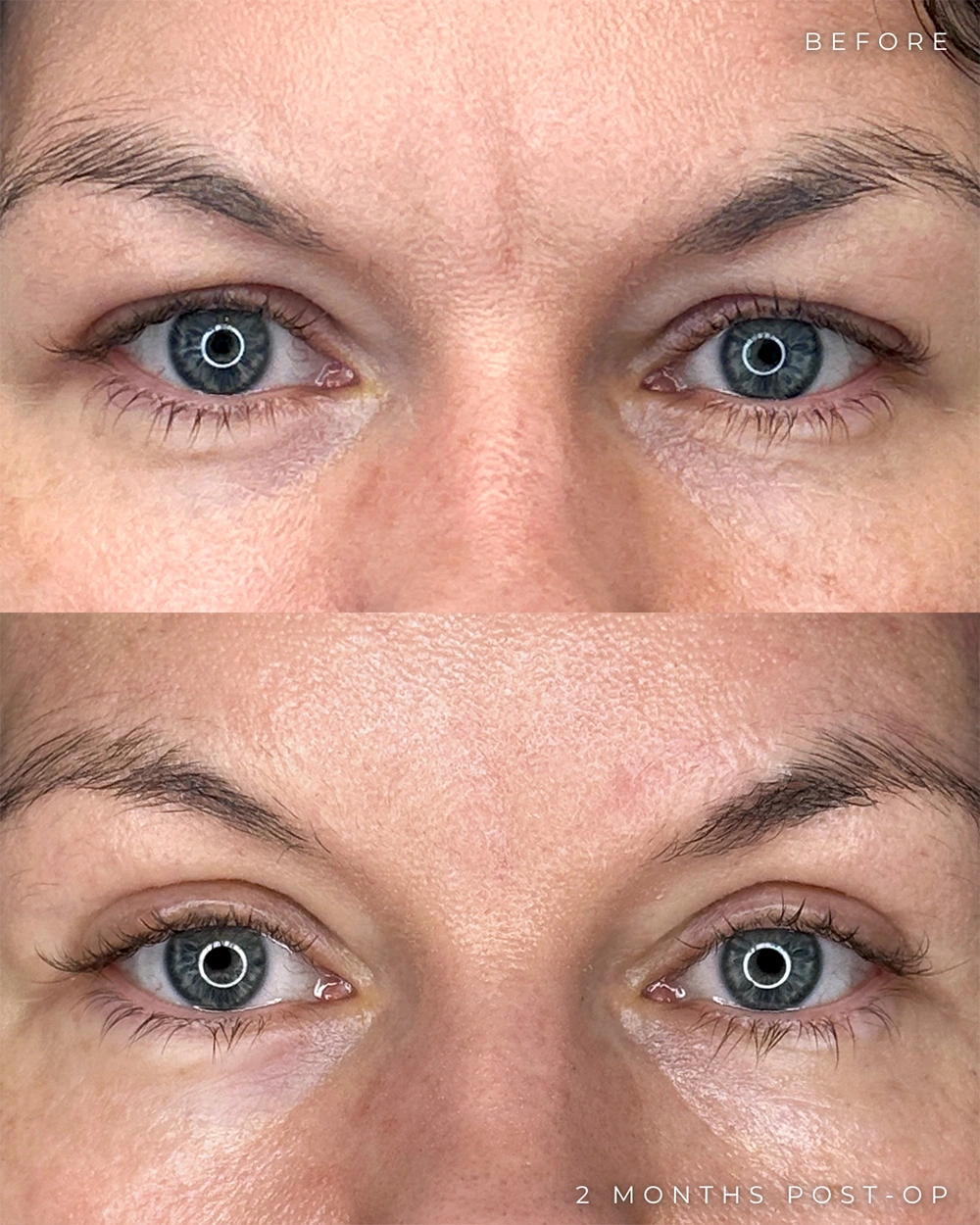 Real patient results in Montreal, QC Performed by Emily Deane, MD