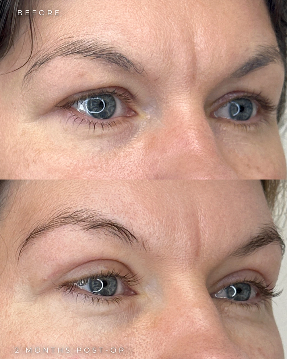 Real patient results in Montreal, QC Performed by Emily Deane, MD