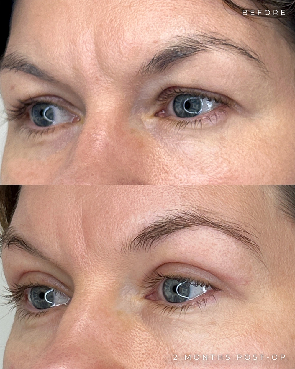 Real patient results in Montreal, QC Performed by Emily Deane, MD