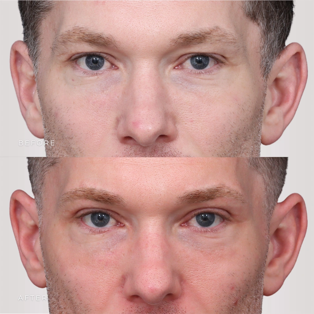Real patient results in Montreal, QC Performed by Emily Deane, MD