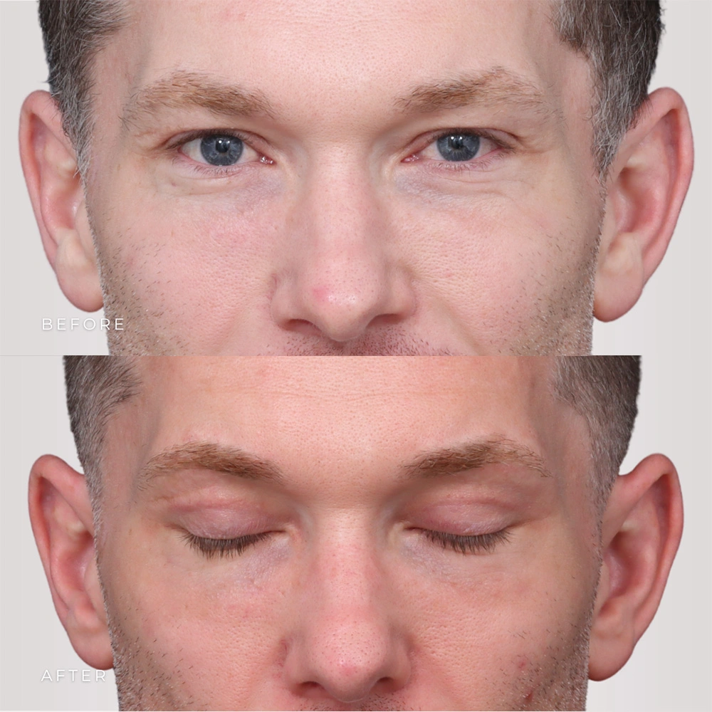 Real patient results in Montreal, QC Performed by Emily Deane, MD