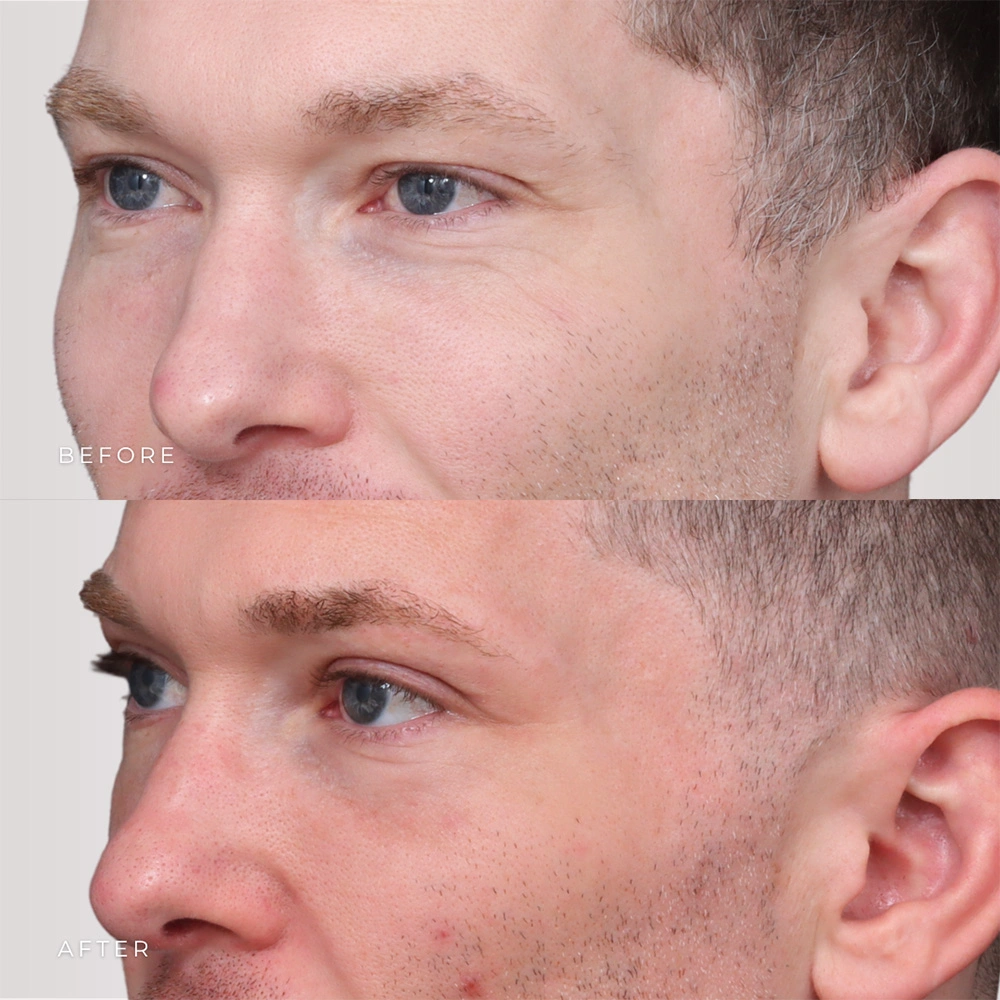 Real patient results in Montreal, QC Performed by Emily Deane, MD