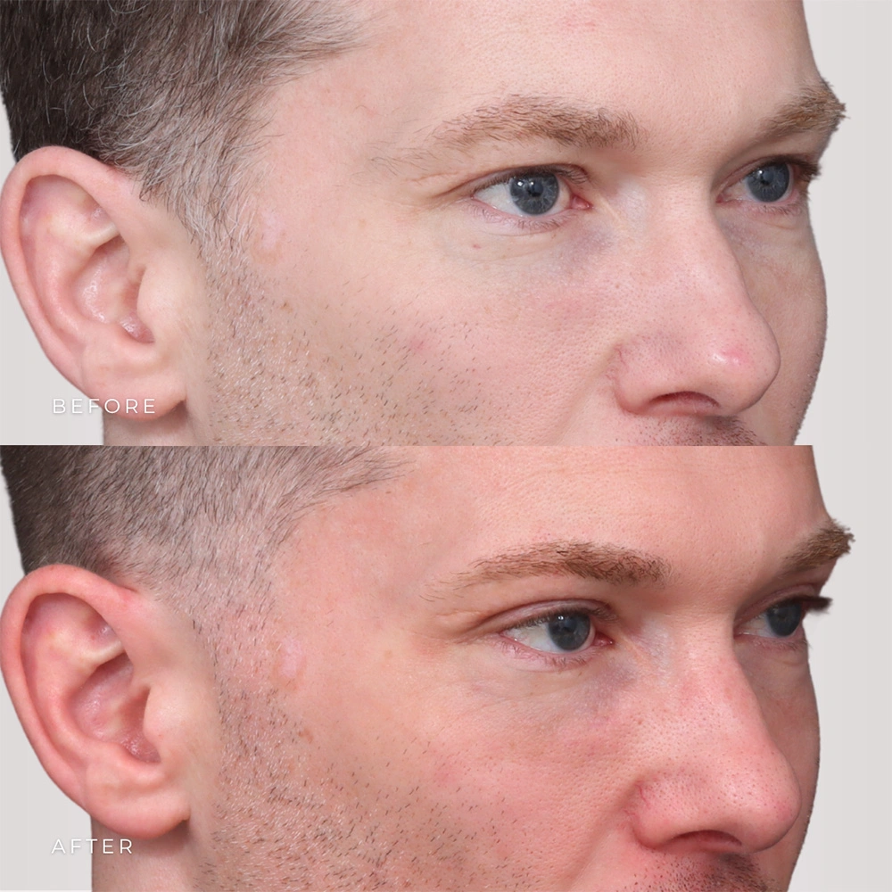 Real patient results in Montreal, QC Performed by Emily Deane, MD