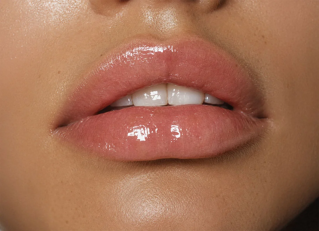 Natural-looking lip filler results showing enhanced, glossy lips with subtle volume and defined shape - Lip filler in Montreal, QC