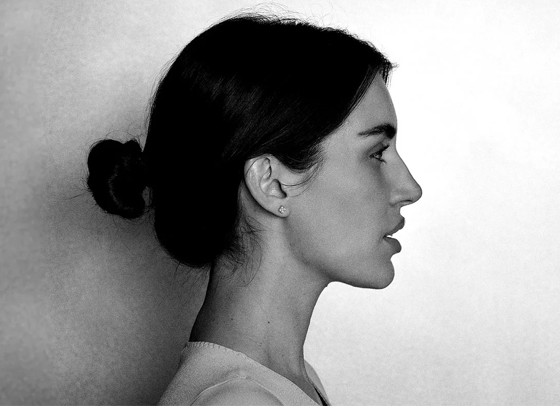 Woman's profile showing neck and jawline contour before neck liposuction procedure - Neck liposuction in Montreal, QC