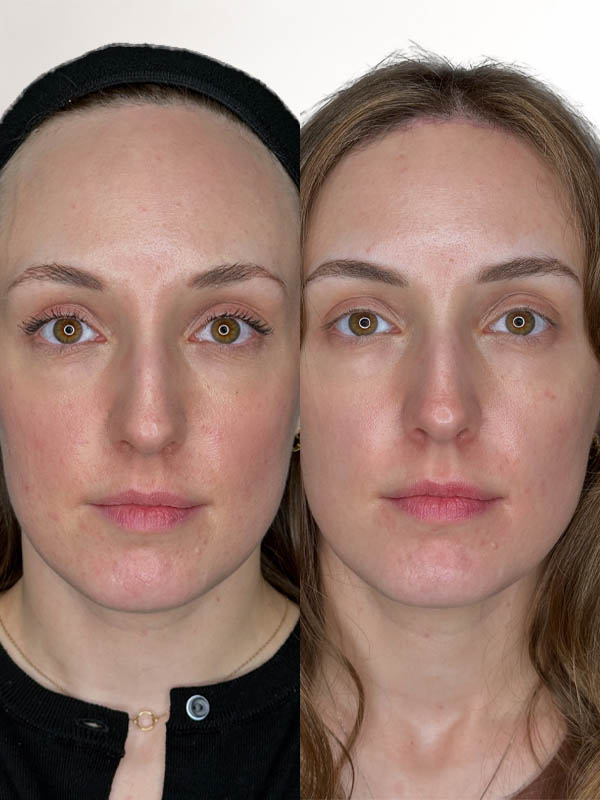 1_0005_foreheadreduc-2mon (4).JPG