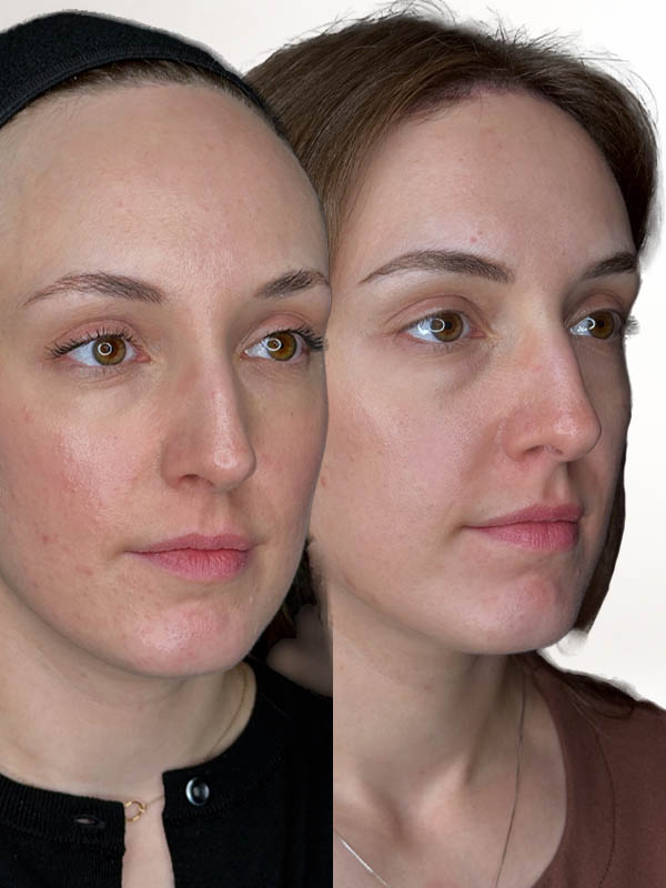1_0006_foreheadreduc-2mon (6).JPG