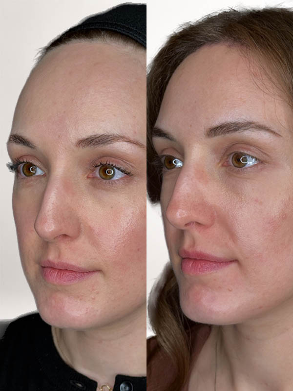 1_0007_foreheadreduc-2mon (5).JPG