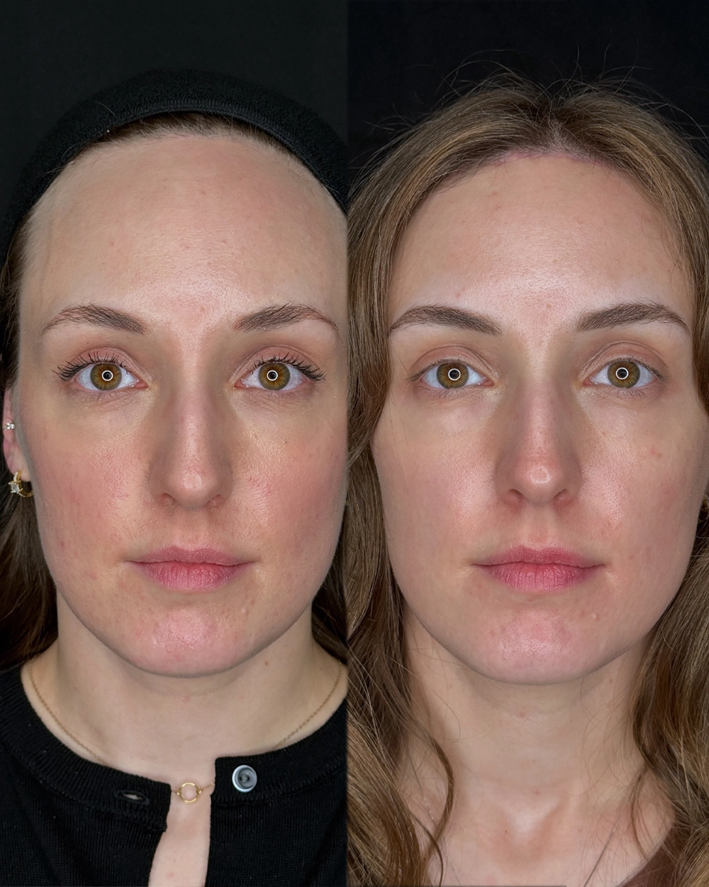 Forehead-Full-IS (4).JPG