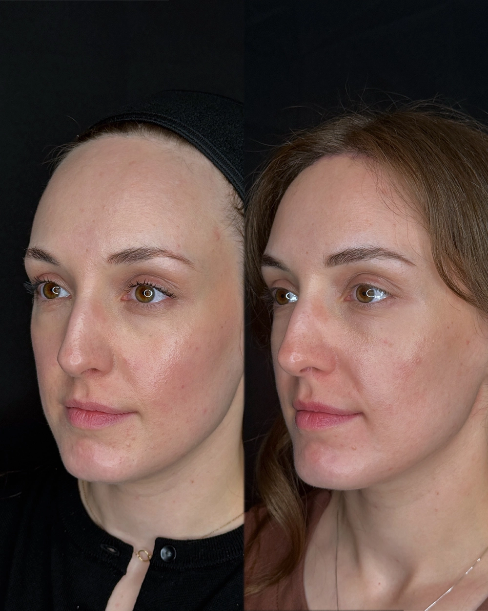 Forehead-Full-IS (5).JPG