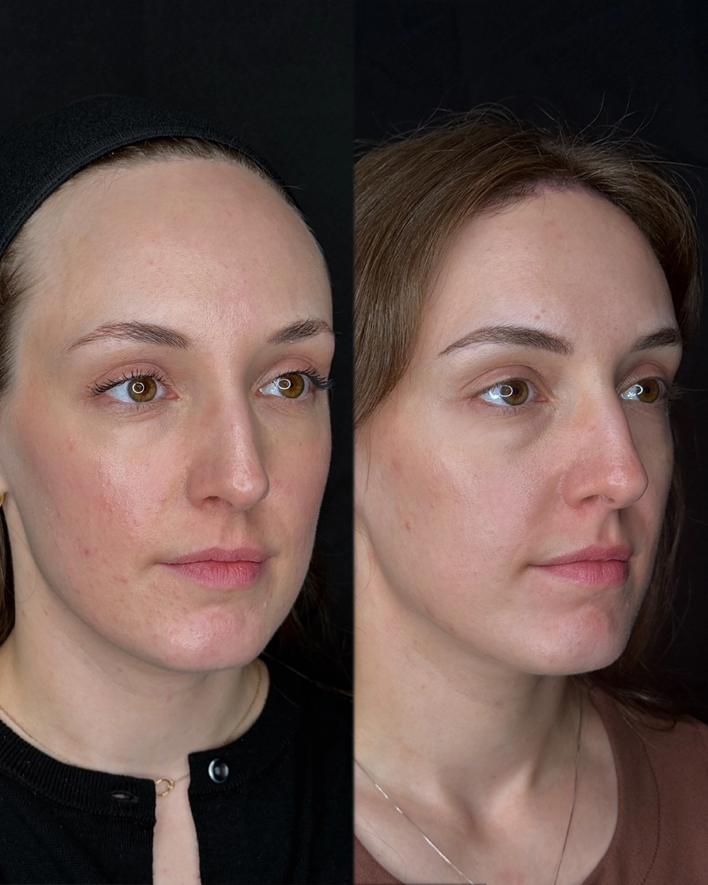 Forehead-Full-IS (6).JPG