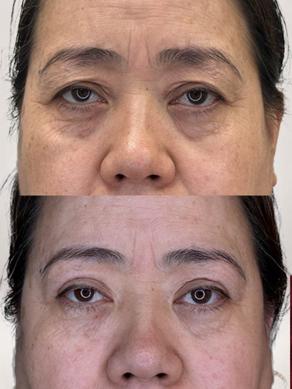 partial_0050_UblephMM1year (1).JPG