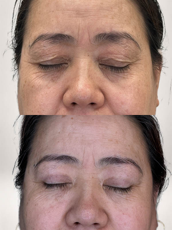partial_0055_UblephMM1year (2).JPG